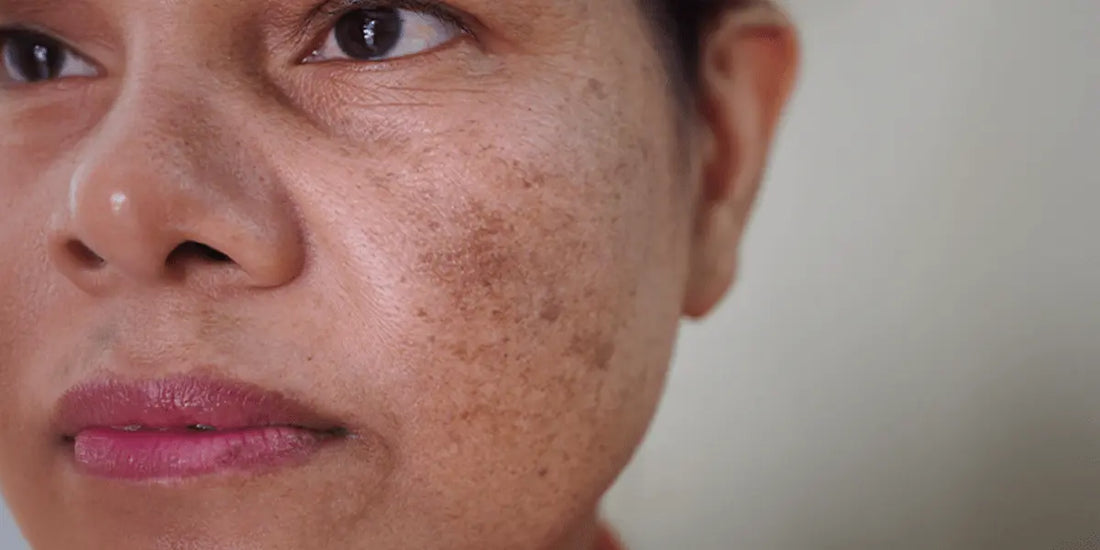 What Causes Hyperpigmentation? The Real Science Behind Dark Spots and How to Restore Even Skin Tone Naturally